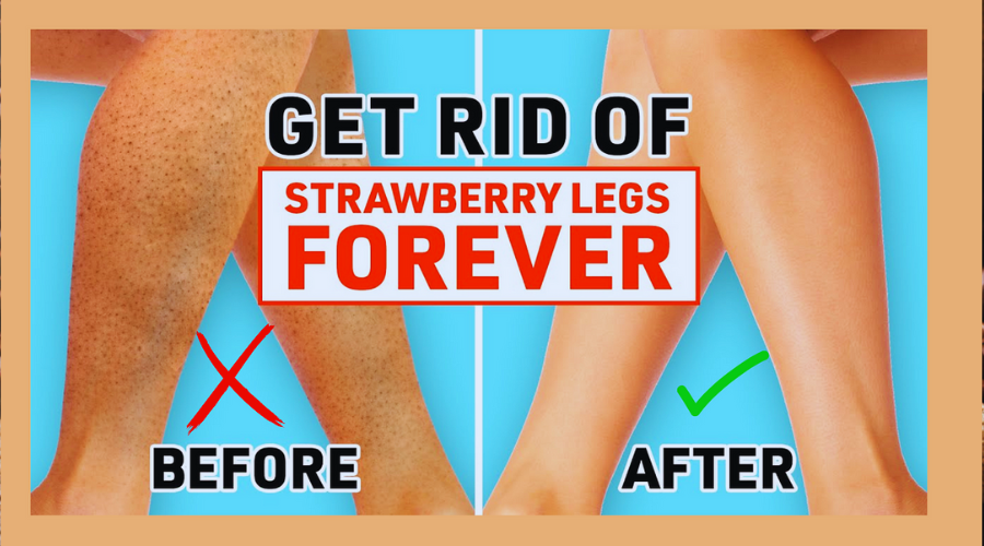 6 Ways To Get Rid of Strawberry Legs