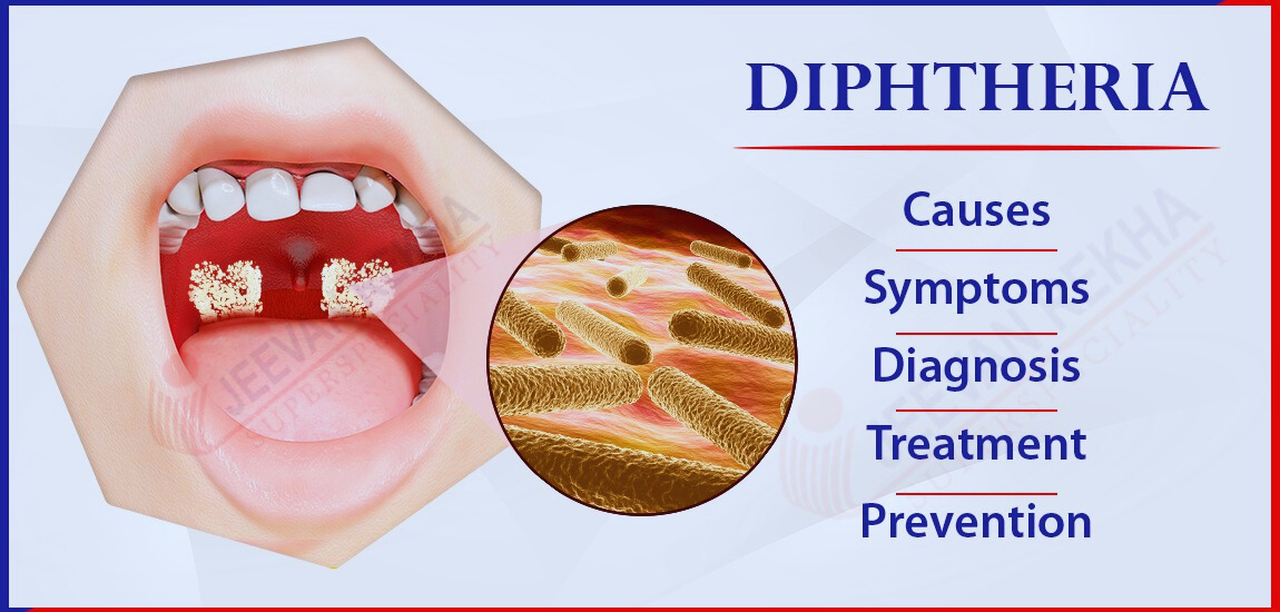 Symptoms and Treatment Options for Diphtheria?