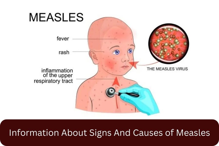 Information About Signs And Causes of Measles