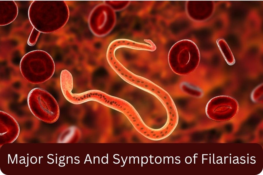 Major Signs And Symptoms of Filariasis