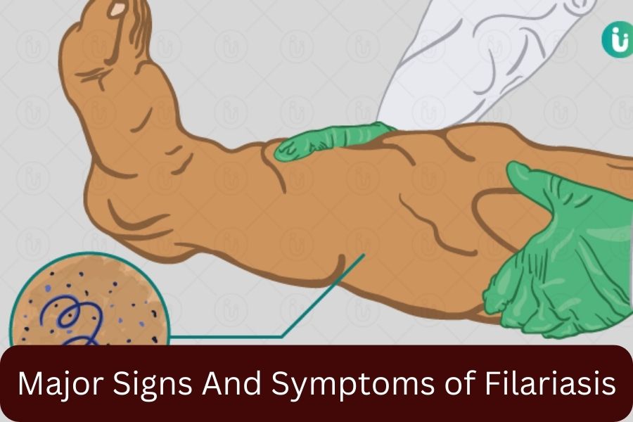 Major Signs And Symptoms of Filariasis