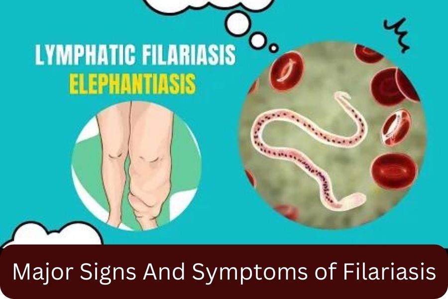 Major Signs And Symptoms of Filariasis